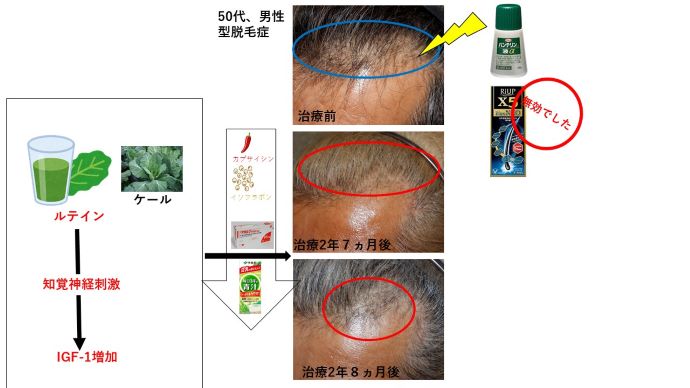 円形脱毛症　病院